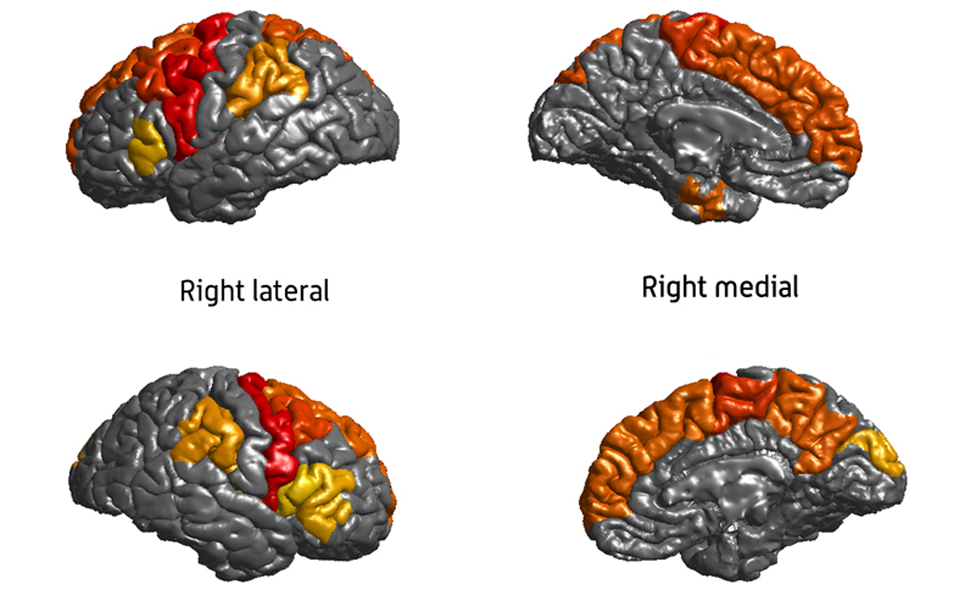 Epilepsy linked to brain volume and thickness differences