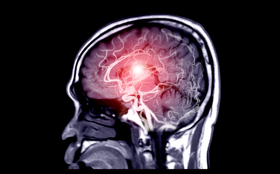 Georgia State Researchers Reveal Surprising Findings on How Salt Affects Blood Flow in the Brain. Image Credit: Georgia State University.